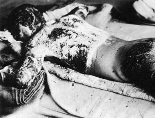 atomic bomb victim